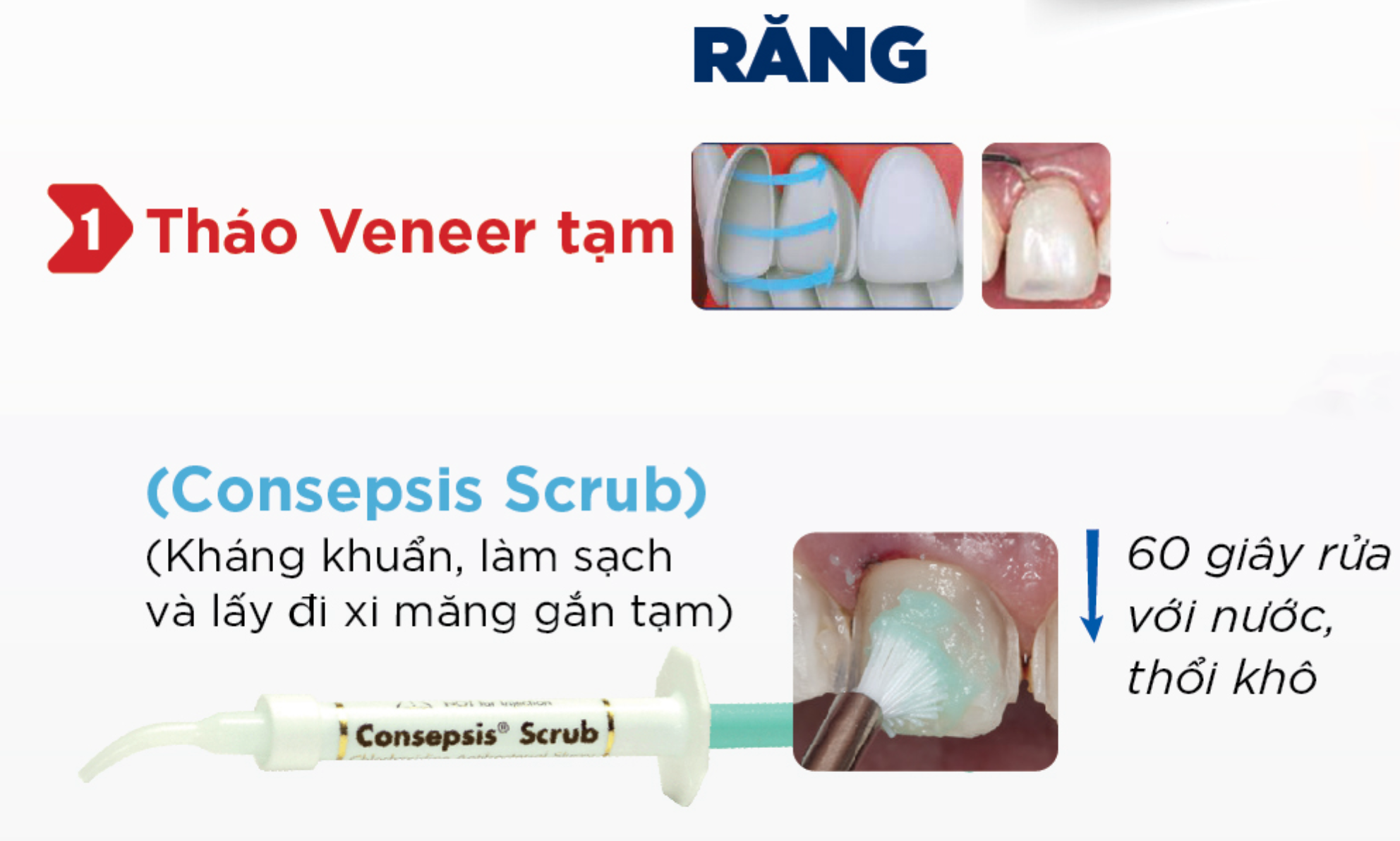 Các bước sử dụng bộ vật liệu gắn mặt dán sứ veneer của hãng Ultradent🌱NHA KHOA MALL🌱